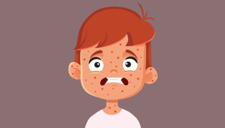 زنگ خطر شیوع سرخک در استان یزد: لزوم توجه به واکسیناسیون