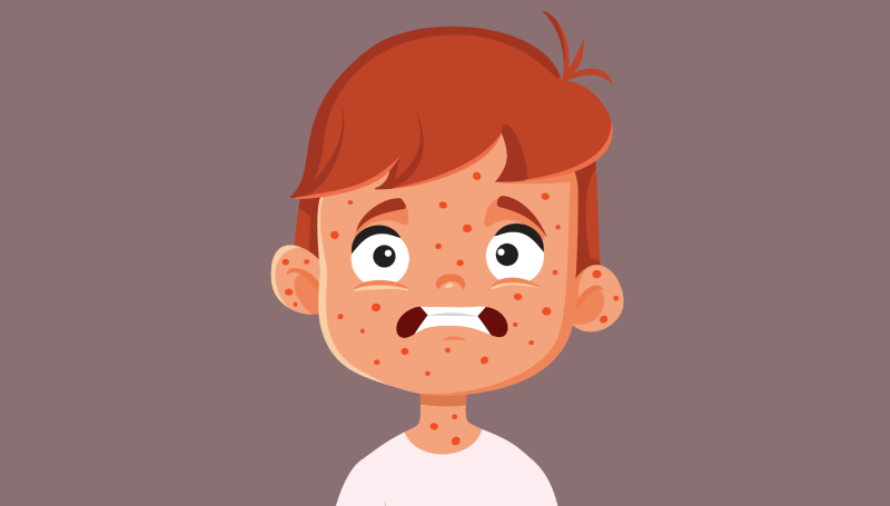 زنگ خطر شیوع سرخک در استان یزد: لزوم توجه به واکسیناسیون