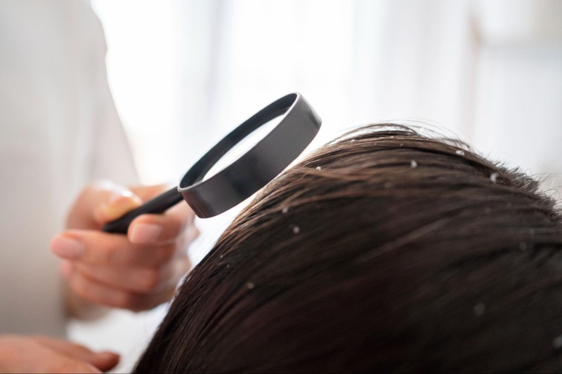 علت خشکی پوست و شوره سر چیست؟ بررسی نقش ویتامین‌ها در سلامت پوست و مو