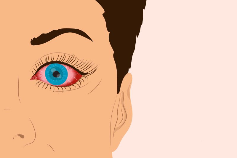 عوارض چشمی کرونا: اهمیت توجه به علائم چشمی در بیماران مبتلا به کووید-19