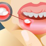 آفت دهان چیست؟ روش‌ های طبیعی برای درمان سریع آفت دهانی