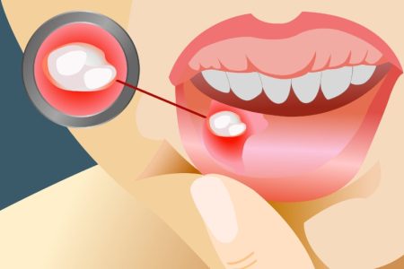 آفت دهان چیست؟ روش‌ های طبیعی برای درمان سریع آفت دهانی