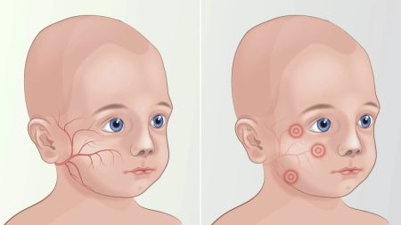 علائم هشداردهنده ابتلا به فنیل کتونوری در کودکان و روش‌ های درمان آن