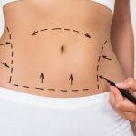 جراحی های لاغری چگونه جذب آهن و ویتامین ها را مختل می کنند؟