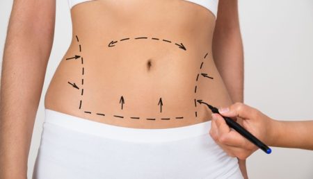 جراحی های لاغری چگونه جذب آهن و ویتامین ها را مختل می کنند؟
