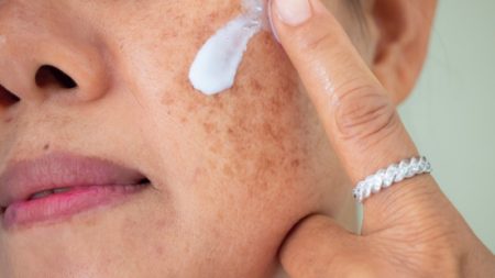 نکات بسیار مهم درباره لک‌ های پوستی