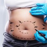 چگونه از کم‌ خونی و بازگشت وزن پس از جراحی لاغری جلوگیری کنیم؟