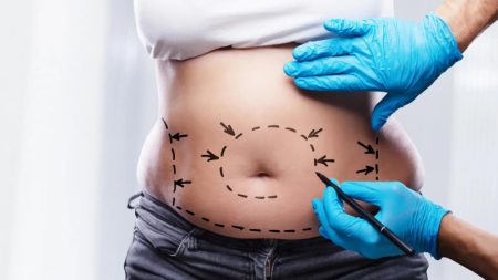 چگونه از کم‌ خونی و بازگشت وزن پس از جراحی لاغری جلوگیری کنیم؟
