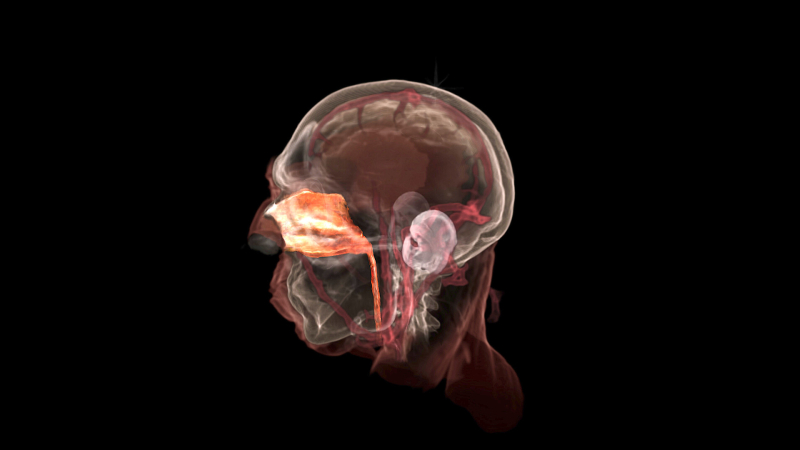 آیا خر و پف می‌ تواند نشانه یک سرطان نادر باشد؟ توضیح پزشکان درباره نوروبلاستوم بویایی