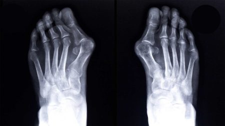 تشخیص زود هنگام انحراف شست پا و روش‌ های مؤثر درمانی