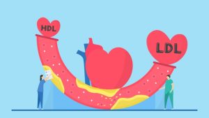 ارتباط بین سطح پایین LDL و افزایش خطر دیابت نوع ۲: یافته‌ های جدید