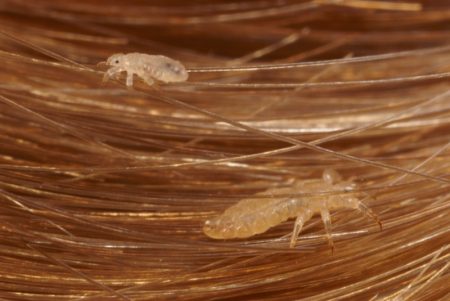 شپش سر؛ حشره‌ ای کوچک که سلامت مو و پوست سر را تهدید می‌ کند