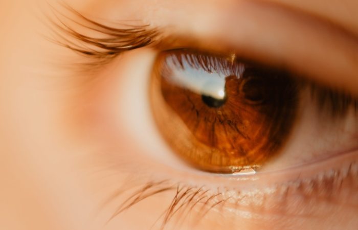 شیوع بالای آب سیاه مادرزادی در ایران و نقش ازدواج‌ های فامیلی