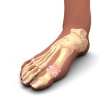 نقرس، علل و درمان طبیعی با تغییر سبک زندگی و تغذیه