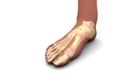 نقرس، علل و درمان طبیعی با تغییر سبک زندگی و تغذیه