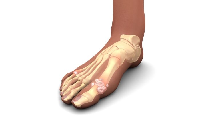 نقرس، علل و درمان طبیعی با تغییر سبک زندگی و تغذیه