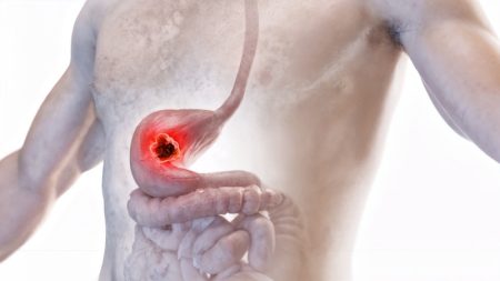 پایان مصرف دارو پس از درمان زخم معده: راهنمای کامل و نکات ضروری