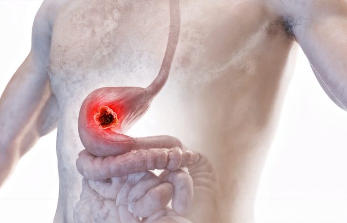 پایان مصرف دارو پس از درمان زخم معده: راهنمای کامل و نکات ضروری