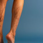 چرا واریس خطرناک است و چگونه می‌ توان آن را مدیریت کرد؟