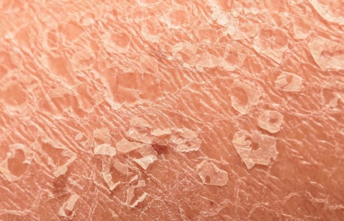 ۱۲ علت شایع پوسته‌ پوسته شدن پوست + پیشگیری و درمان