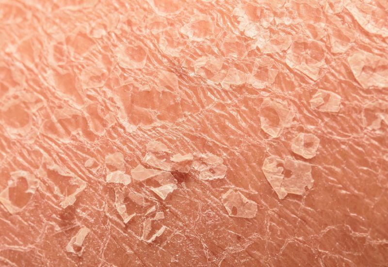 ۱۲ علت شایع پوسته‌ پوسته شدن پوست + پیشگیری و درمان