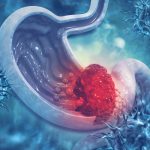 شناسایی سرطان معده در مراحل اولیه با ۵ علامت هشدار دهنده