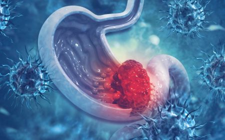 شناسایی سرطان معده در مراحل اولیه با ۵ علامت هشدار دهنده