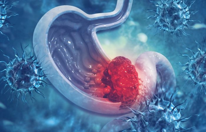 شناسایی سرطان معده در مراحل اولیه با ۵ علامت هشدار دهنده