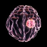 تومور مغزی چیست؟ عوامل خطر، نشانه‌ ها و راهکارهای پیشگیری و تشخیص