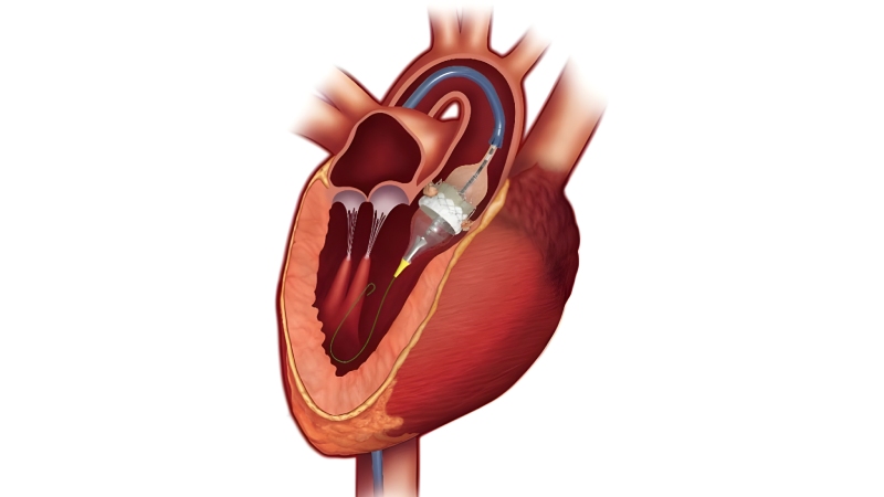 درمان و مدیریت بیماری دریچه قلب
