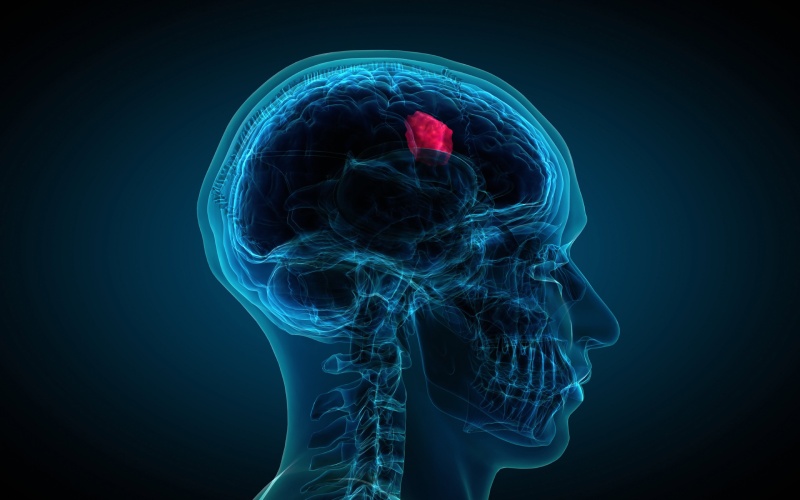 علائم هشدار دهنده تومورهای مغزی و نخاعی