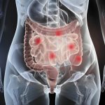 محدود کردن بازه زمانی غذا خوردن: رویکردی نوین در کنترل بیماری کرون