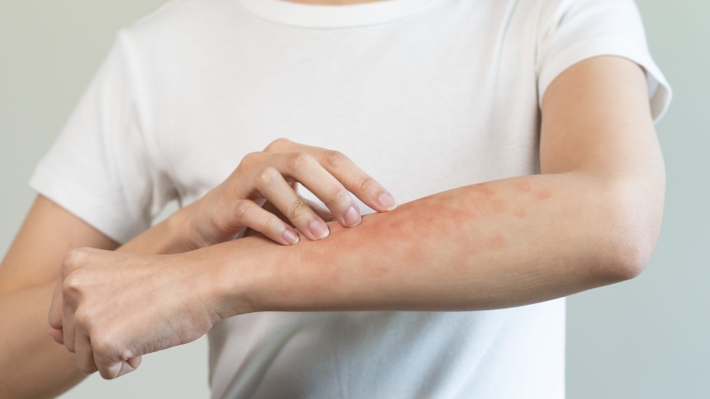 نیش کنه چگونه می تواند باعث حساسیت به گوشت قرمز شود؟